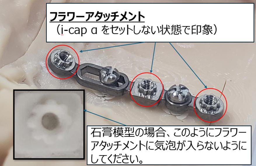 下記の状態での印象を採得してください